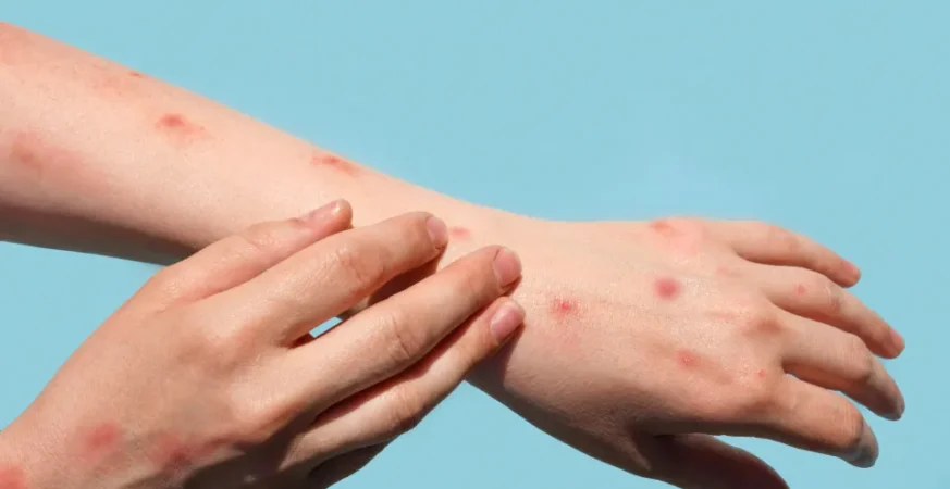 Brasil chega a 140 casos confirmados de mpox em 2026